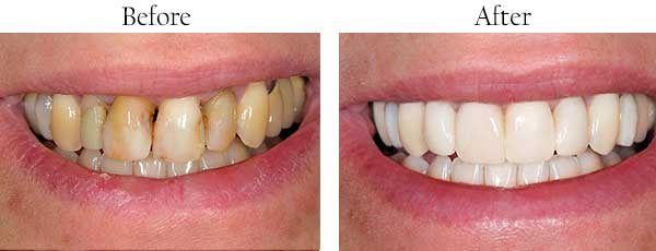Before and After Teeth Whitening Englewood