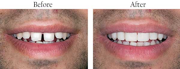 Before and After Dental Fillings Englewood Cliffs