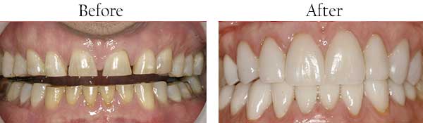Englewood Before and After Dental Images